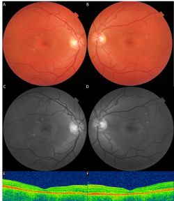 What is Stargardt Disease?